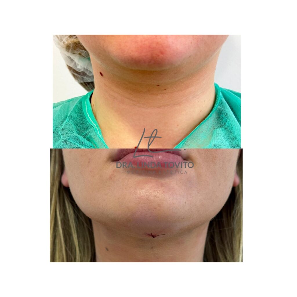 Imagen clínica del tratamiento de LipoLáser de papada realizado por la Dra. Linda Tovito en Madrid.