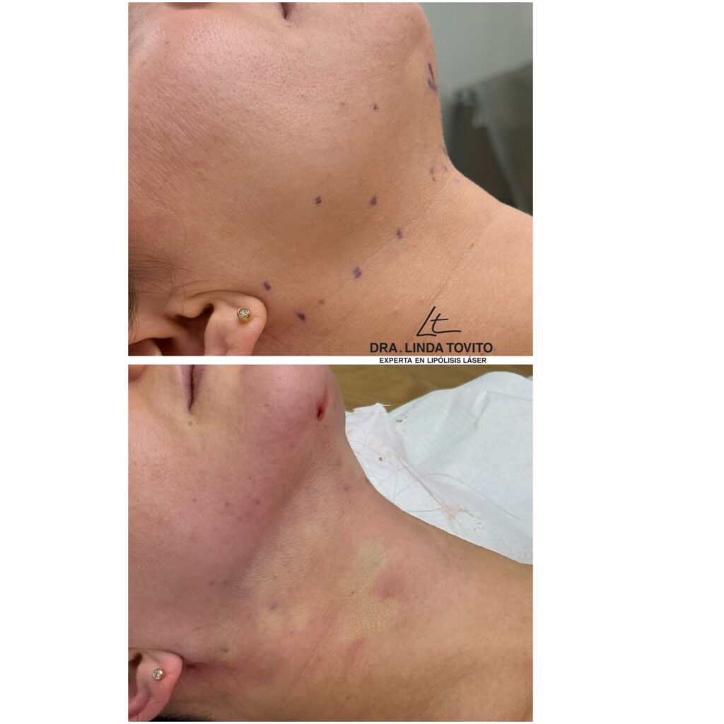 Imagen clínica del tratamiento de LipoLáser de papada realizado por la Dra. Linda Tovito en Madrid.