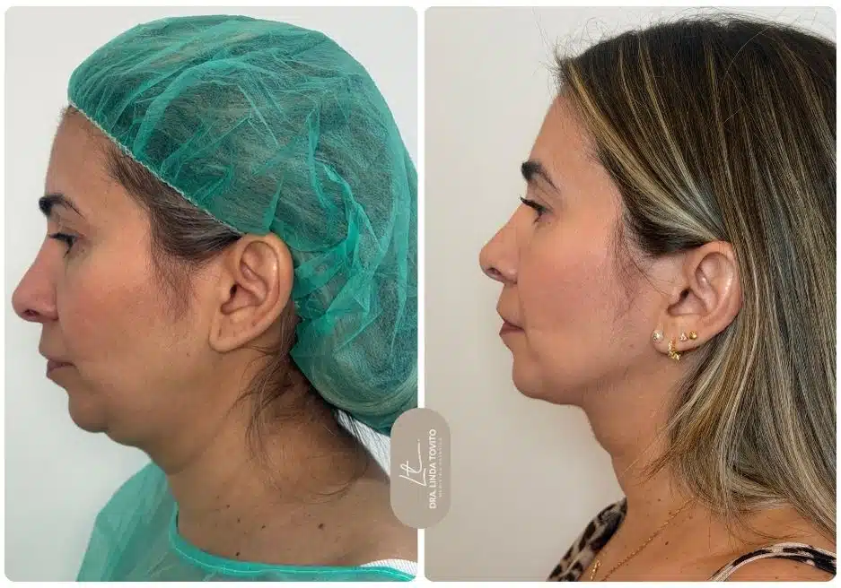 Caso real tratado por la Dra. Linda Tovito con tecnología DEKA Smartlipo® en Madrid.