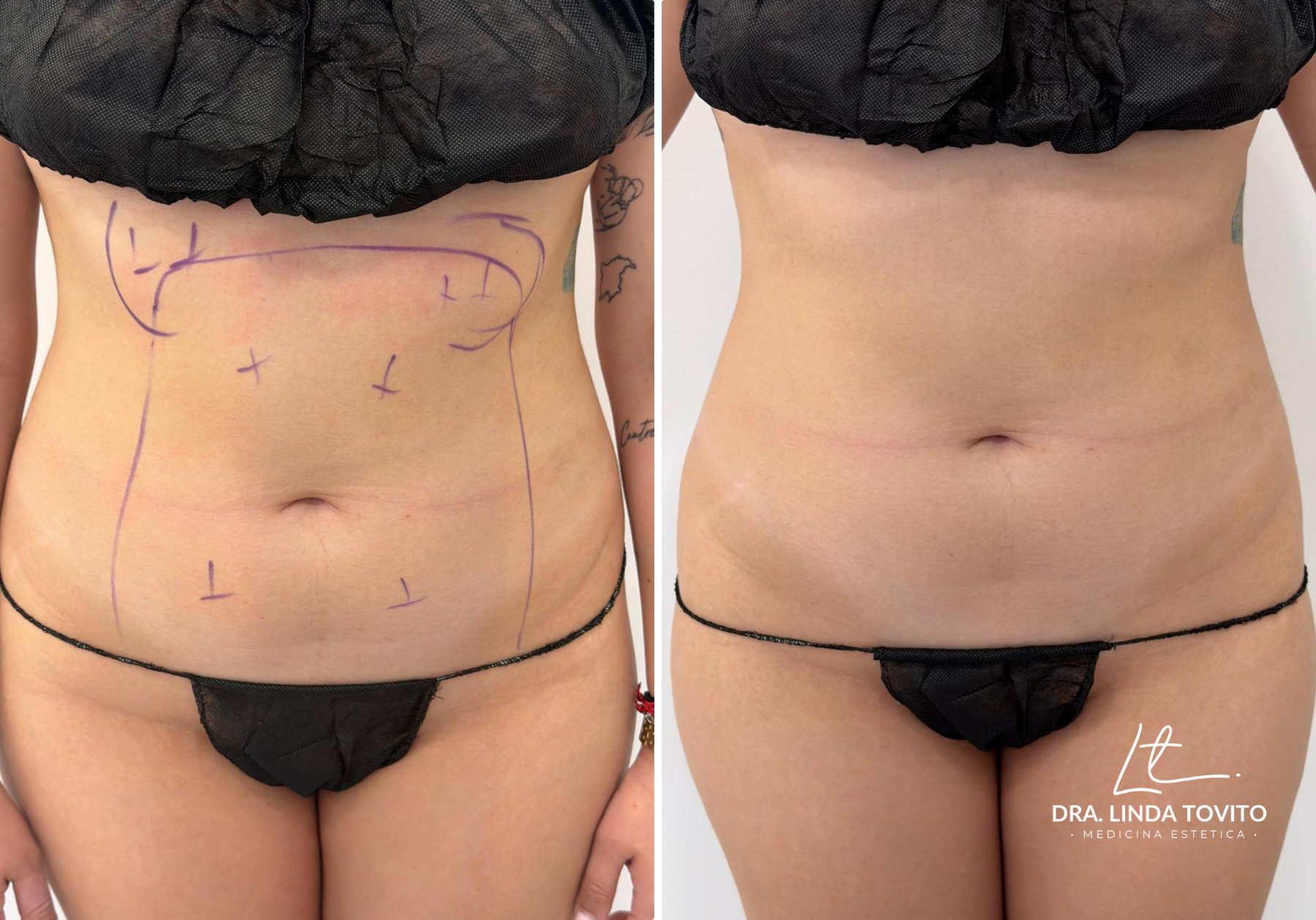 Antes y después de lipoláser en abdomen, caso 2 · Dra. Linda Tovito, clínica de medicina estética en Madrid