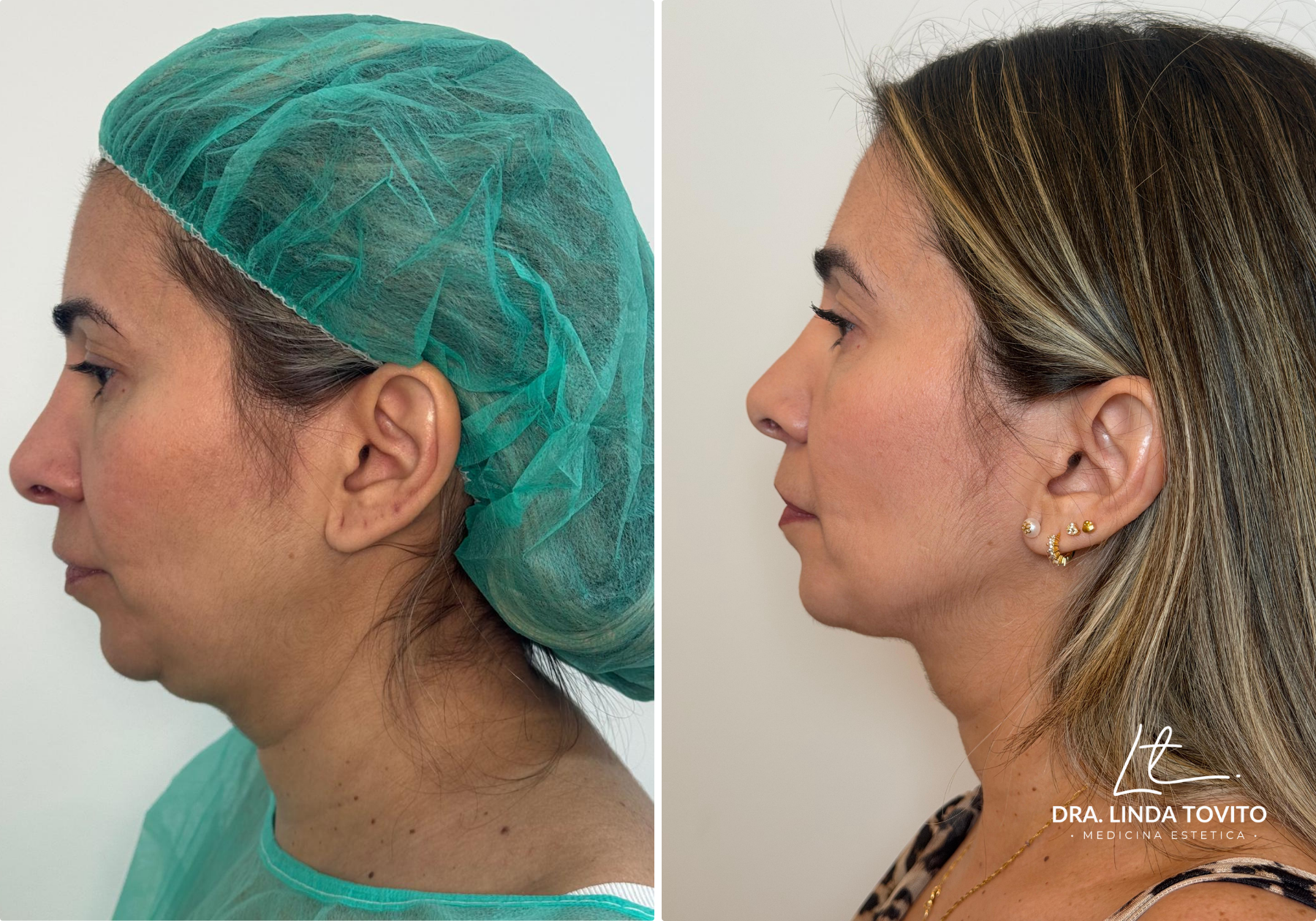 Antes y después de lipoláser en papada, caso 2 · Dra. Linda Tovito, clínica de medicina estética en Madrid