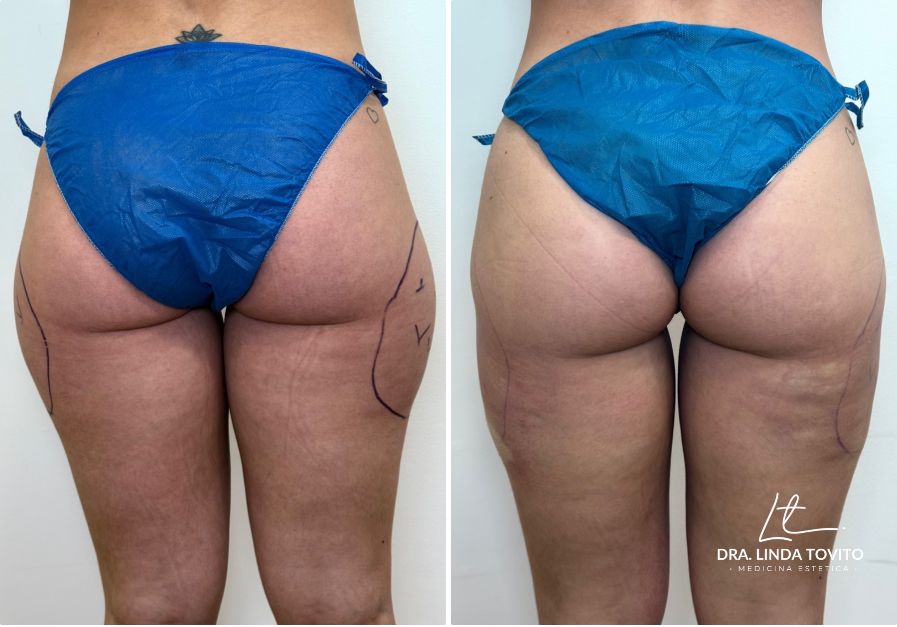 Antes y después de lipoláser en cartucheras, caso 1 · Dra. Linda Tovito, clínica de medicina estética en Madrid