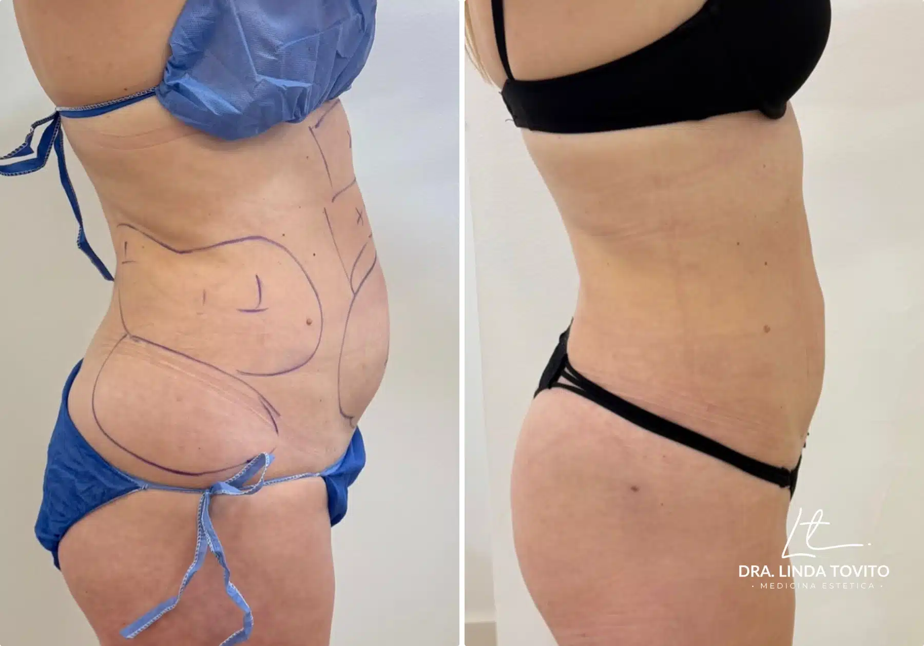 Antes y después de lipoláser en abdomen, caso 4 · Dra. Linda Tovito, clínica de medicina estética en Madrid