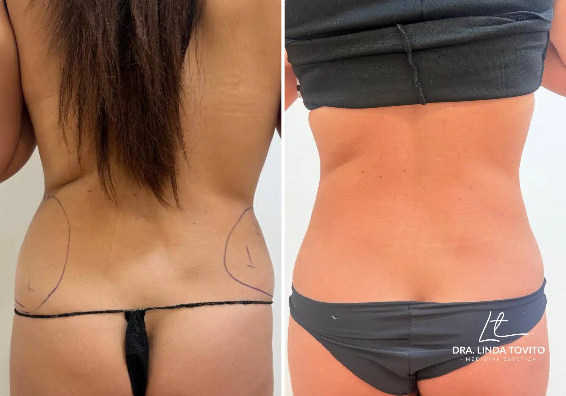 Antes y después de lipoláser en flancos, caso 2 · Dra. Linda Tovito, clínica de medicina estética en Madrid