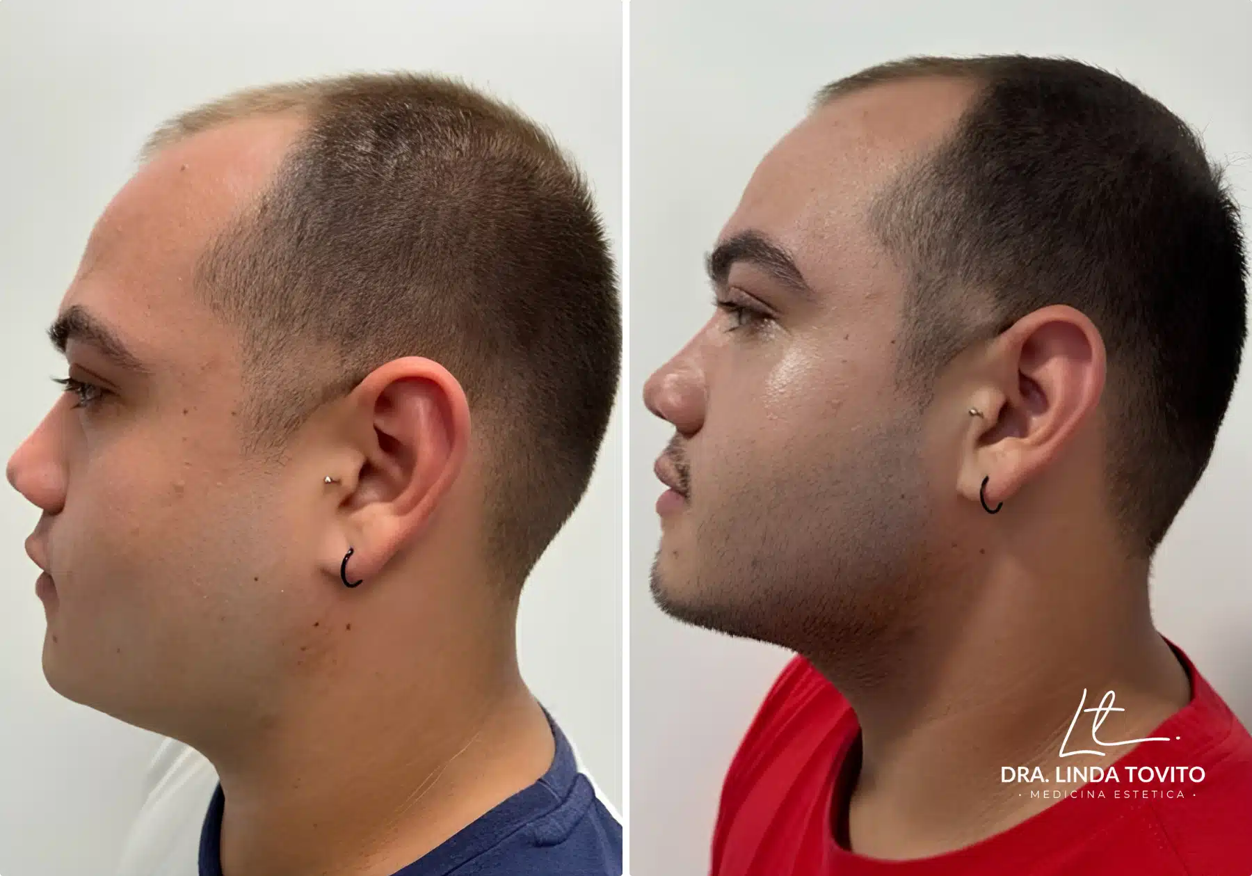 Antes y después de lipoláser en papada, caso 1 · Dra. Linda Tovito, clínica de medicina estética en Madrid