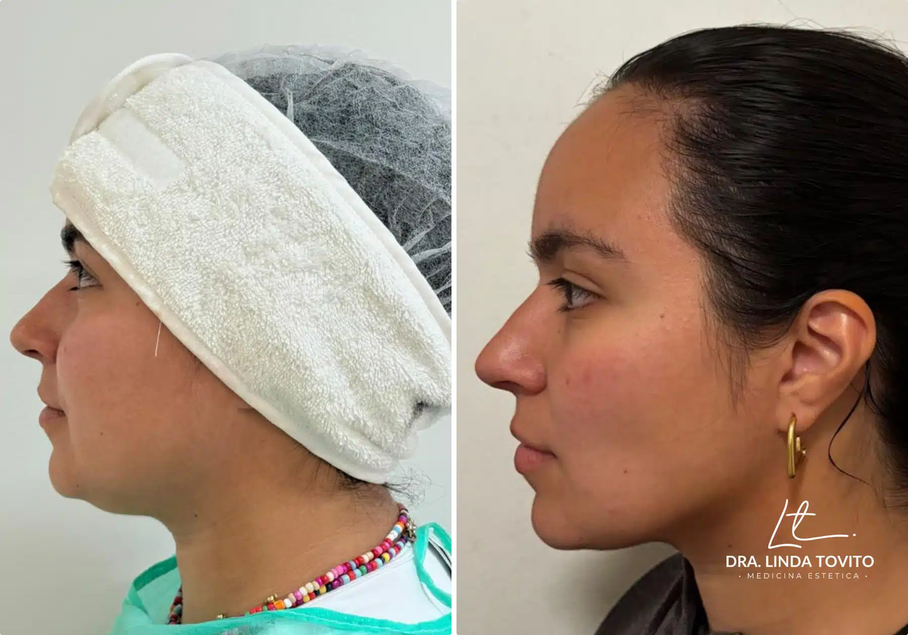 Antes y después de lipoláser de papada realizado por la Dra. Linda Tovito