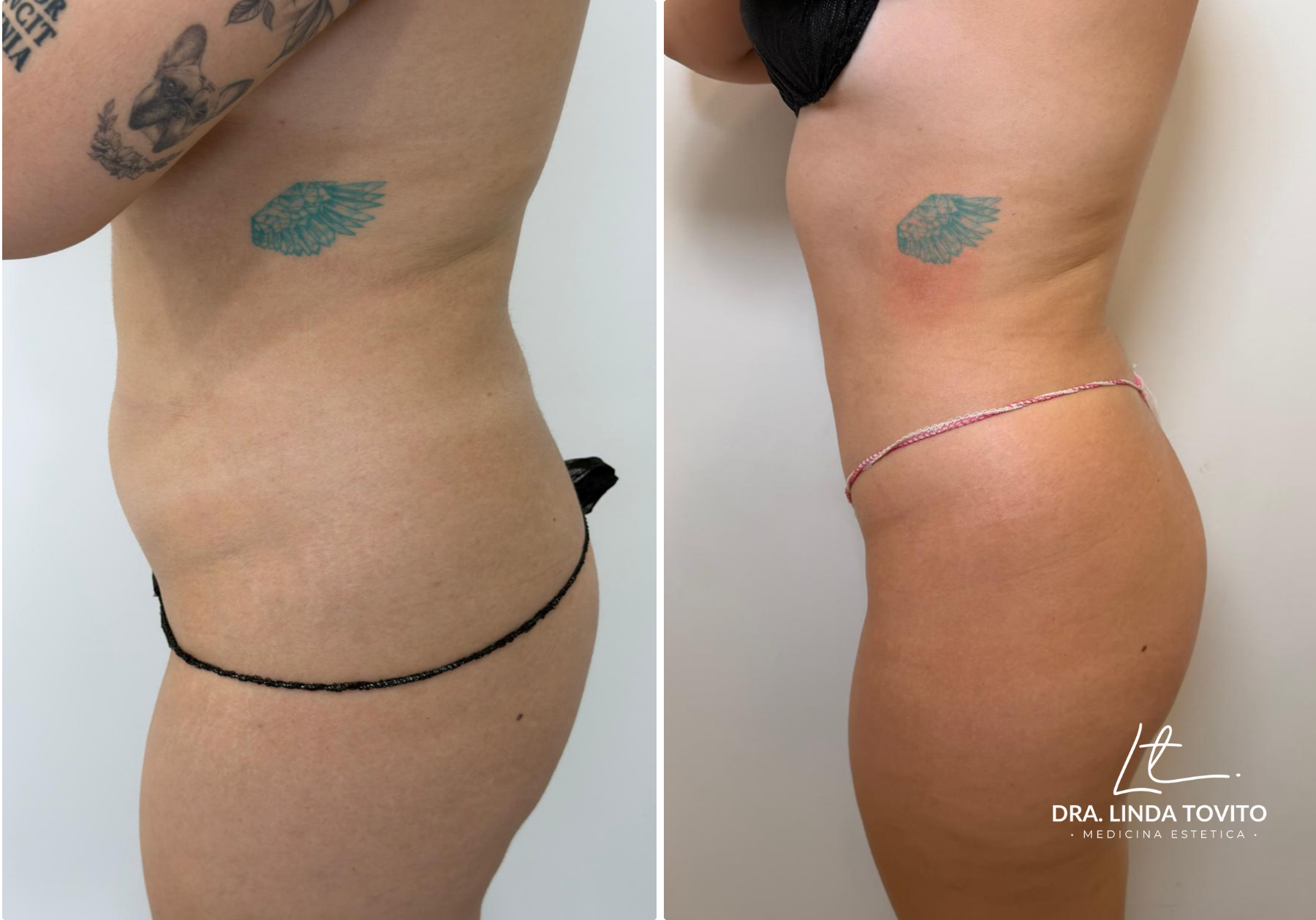 Antes y después de lipoláser en abdomen, caso 1 · Dra. Linda Tovito, clínica de medicina estética en Madrid
