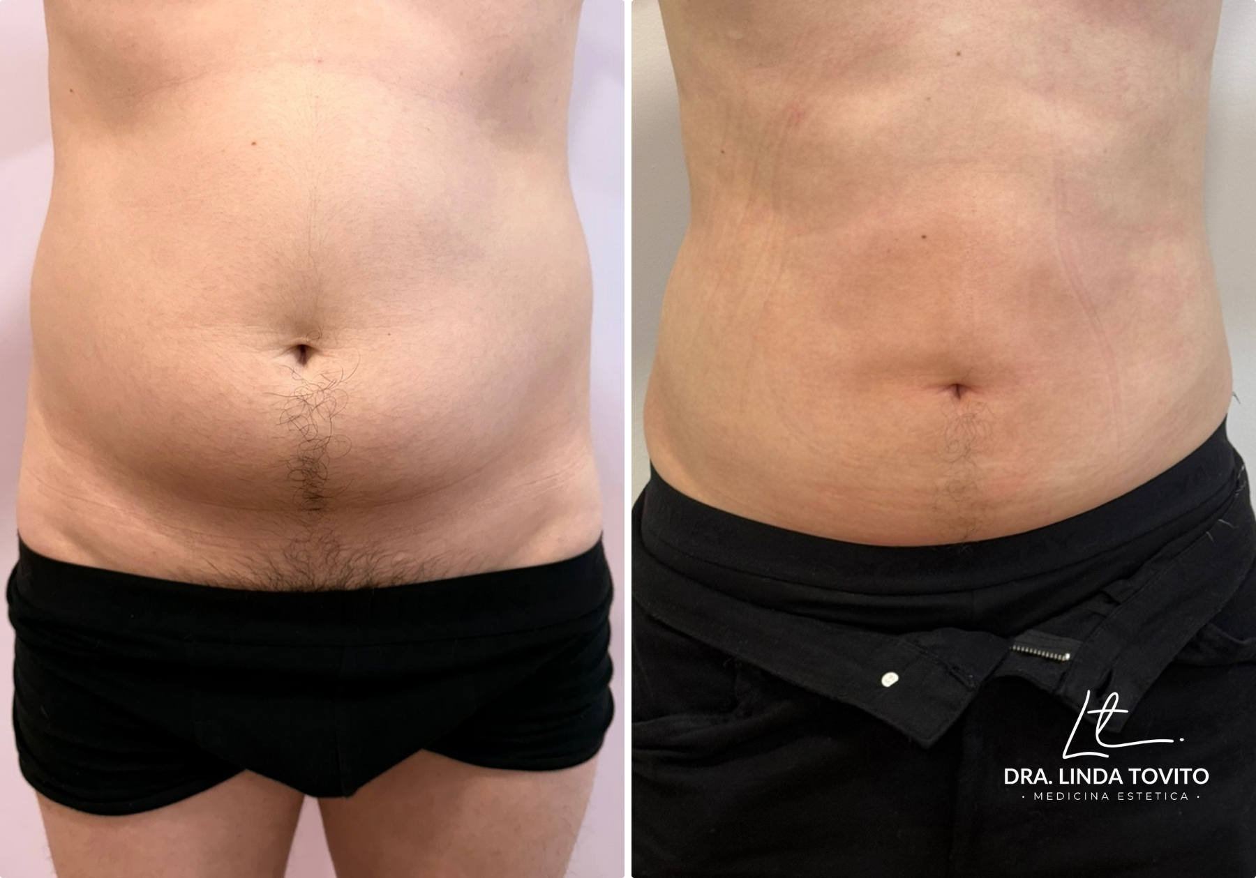 Antes y después de lipoláser en abdomen masculino · Dra. Linda Tovito, clínica de medicina estética en Madrid
