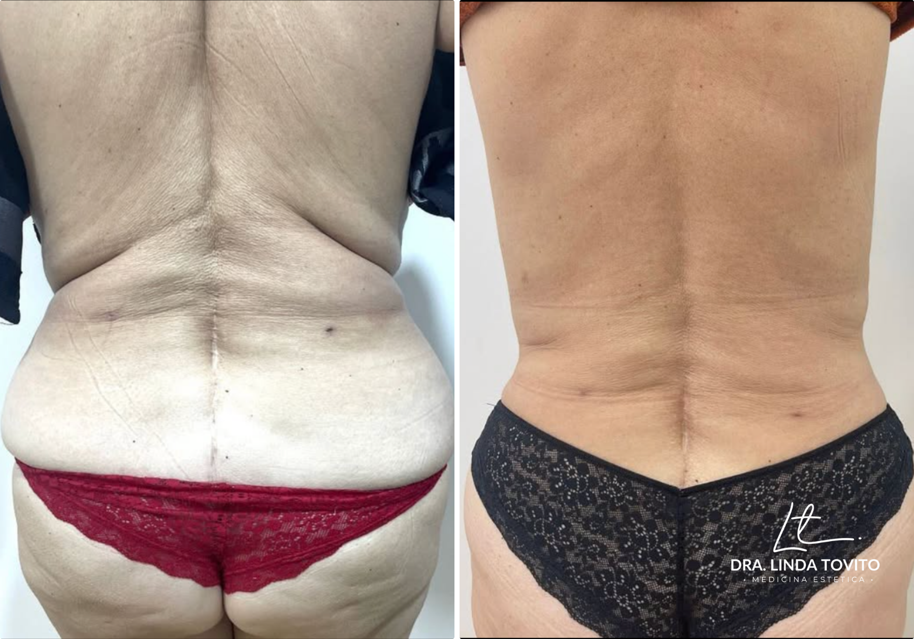 Antes y después de lipoláser en flancos, caso 1 · Dra. Linda Tovito, clínica de medicina estética en Madrid