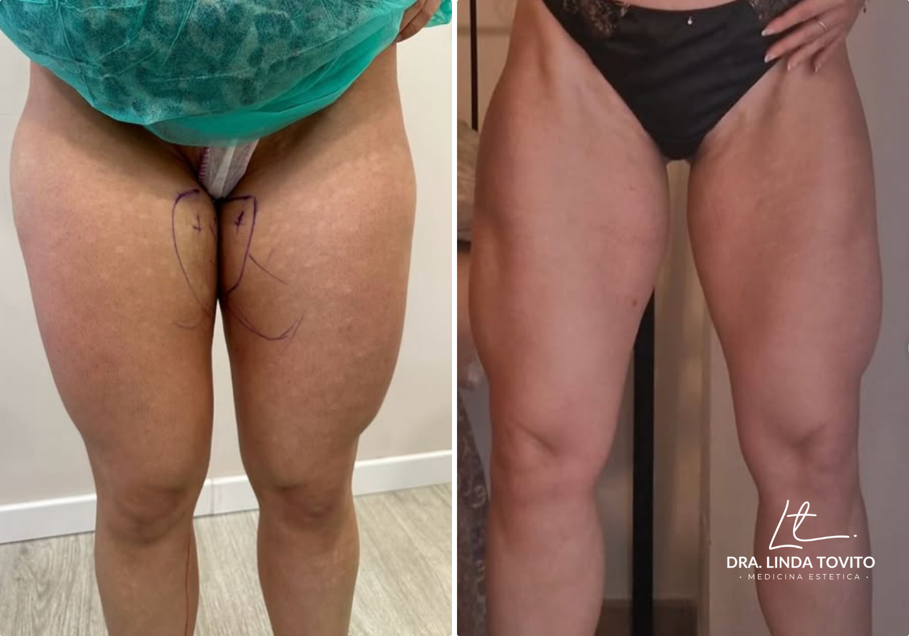 Antes y después de lipoláser en piernas, caso 1 · Dra. Linda Tovito, clínica de medicina estética en Madrid