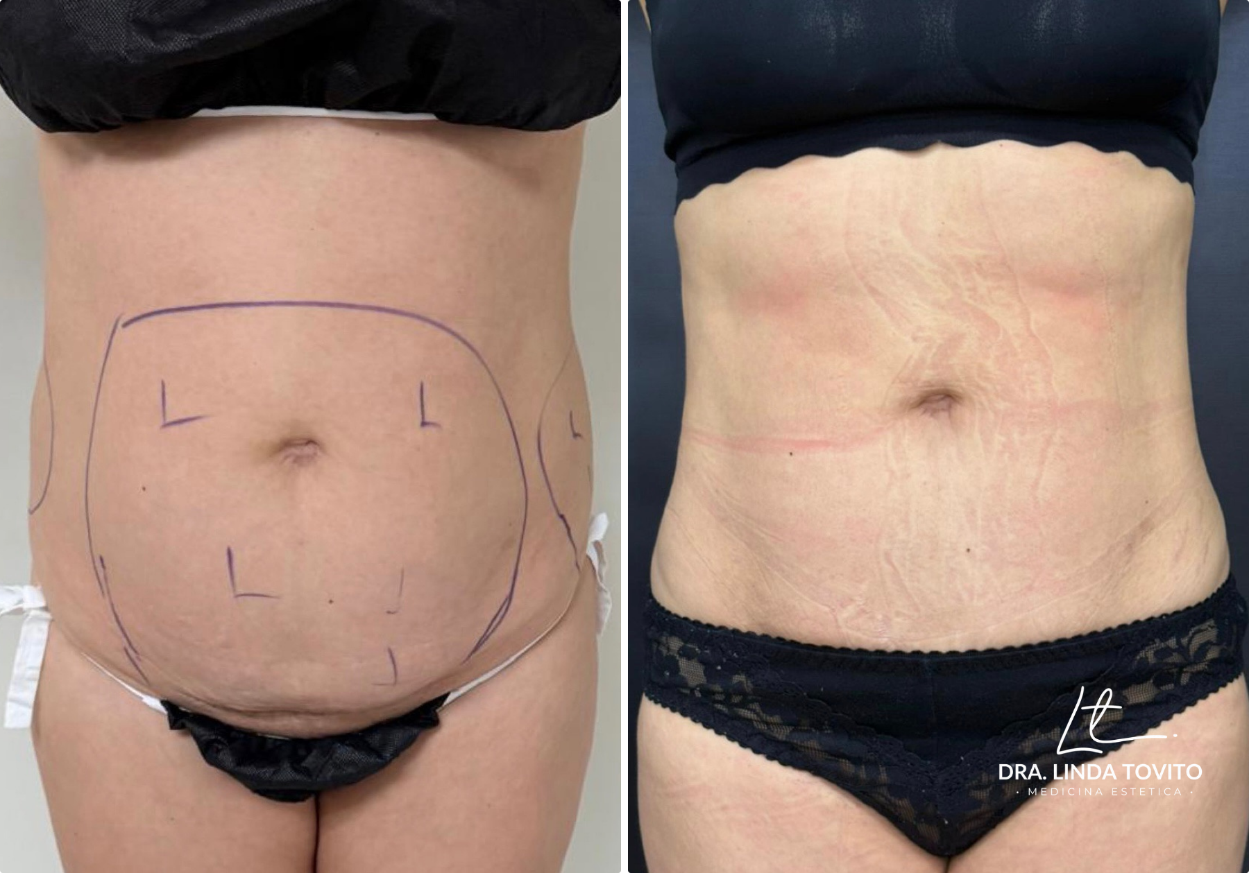 Antes y después de lipoláser en abdomen, caso 3 · Dra. Linda Tovito, clínica de medicina estética en Madrid