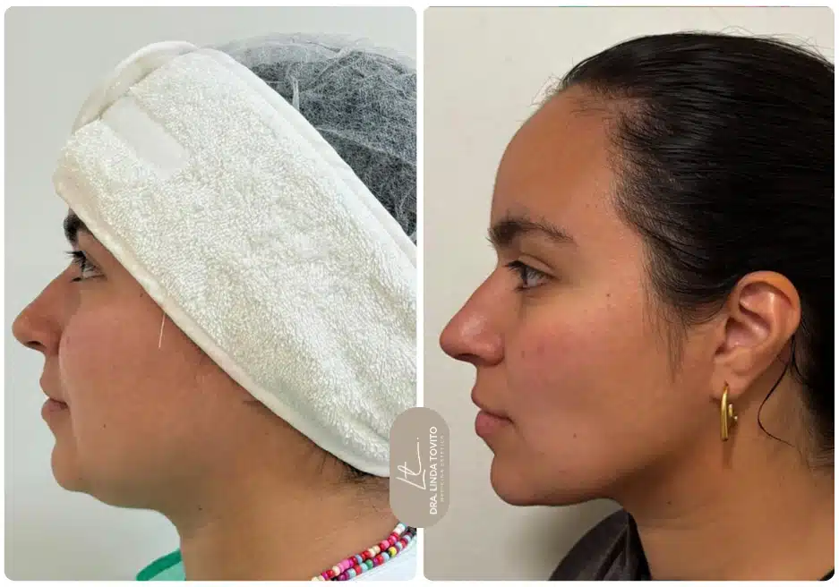 Antes y después de lipoláser de papada realizado por la Dra. Linda Tovito
